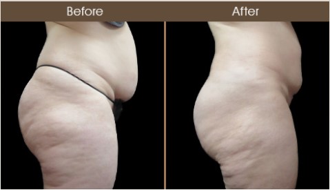 Before & After Gluteal Fat Transfer